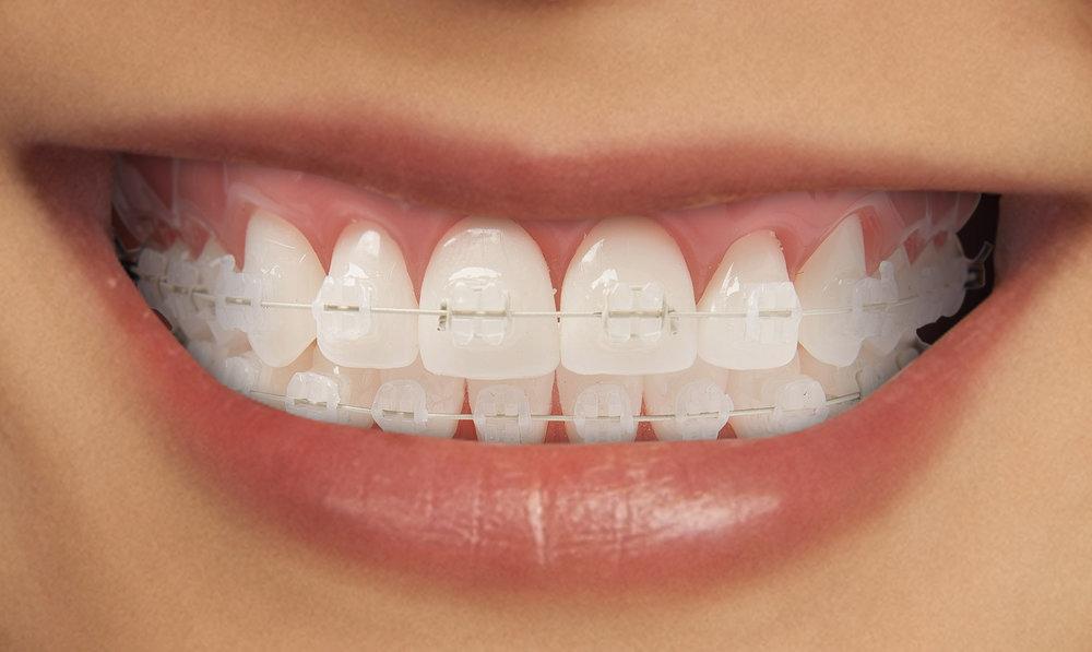 Acrylic braces are also called Invisible braces